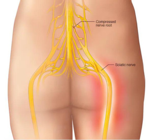 Sciatica Pain